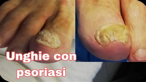 Unghie affette da psoriasi