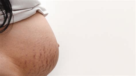 Strie gravidiche sull'addome di una donna incinta