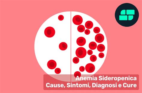 Schema che illustra i sintomi dell'anemia sideropenica, incluse le occhiaie