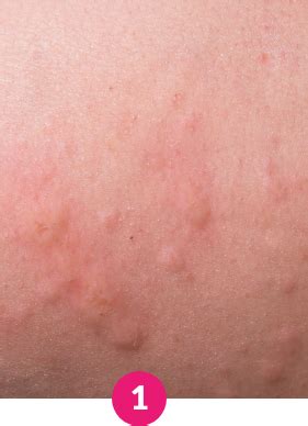 Orticaria con pomfi pruriginosi