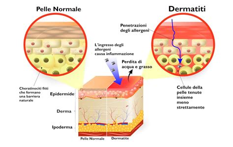 Schema delle cause delle dermatiti estive