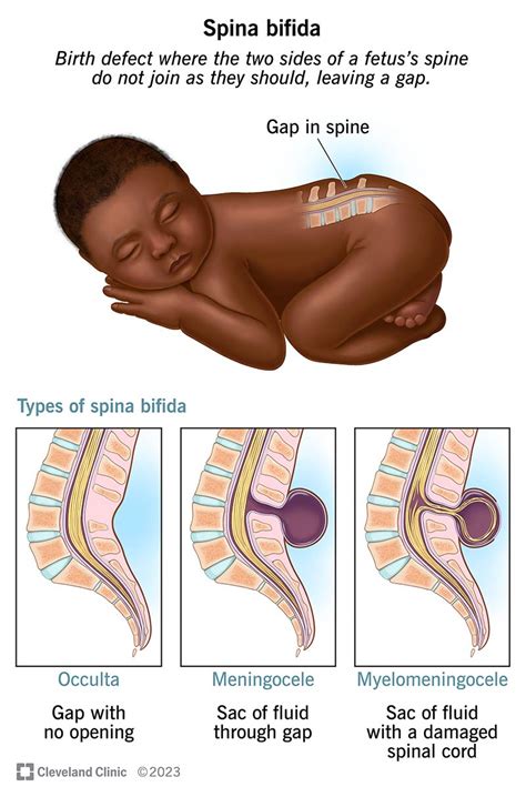 Esempi di segni cutanei associati alla spina bifida occulta