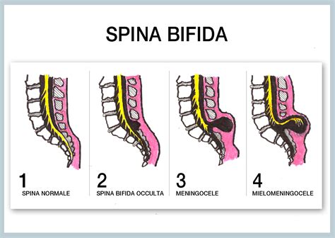 Diagramma che illustra le diverse tipologie di spina bifida