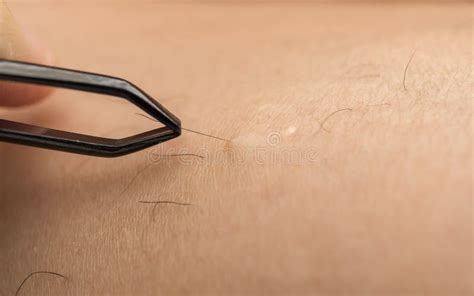 Immagine che mostra una persona che utilizza delle pinzette per rimuovere peli facciali