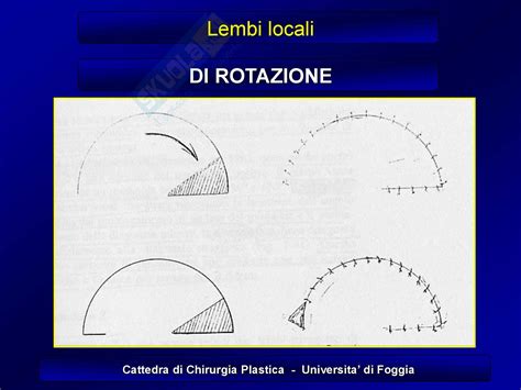 Diagramma che illustra le diverse tipologie di lembi cutanei utilizzati in chirurgia ricostruttiva.