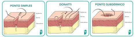 Illustrazione delle diverse tecniche di sutura cutanea, inclusa la sutura continua e la sutura a materasso.