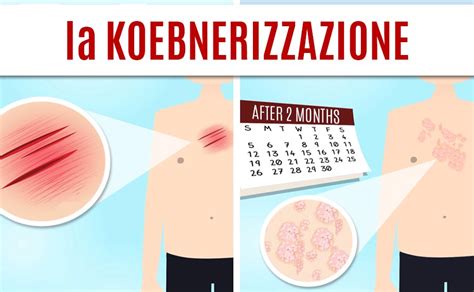 Illustrazione del fenomeno di Koebner su pelle con psoriasi