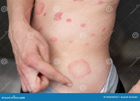 Immagine di pelle con eczema sul collo
