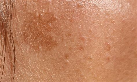 Schema che illustra i diversi tipi di macchie pigmentarie