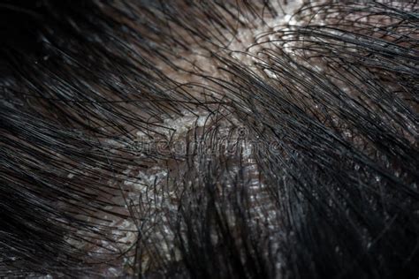 Immagine ravvicinata di squame e arrossamento sul cuoio capelluto e sul viso