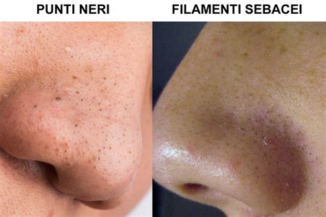 Schema comparativo tra filamenti sebacei e punti neri