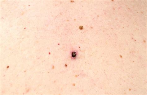 Immagine ravvicinata di un punto nero sul mento