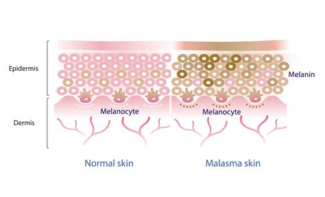 Schema che illustra la formazione del melasma e l'azione depigmentante di alcuni acidi