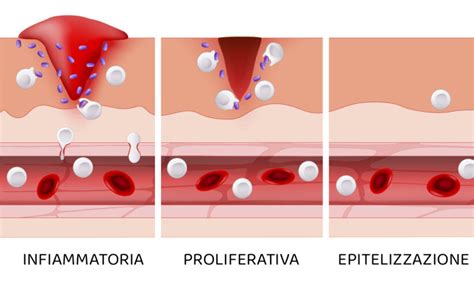 Illustrazione che mostra le diverse fasi di risposta tissutale a un'iniezione di filler, con enfasi sull'edema