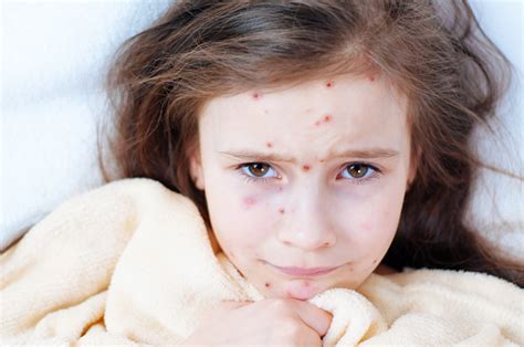 Eruzione cutanea da varicella