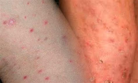 Eruzione cutanea tipica della pitiriasi lichenoide