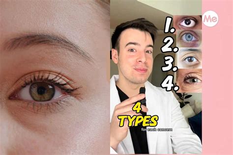 Schema delle diverse tipologie di occhiaie