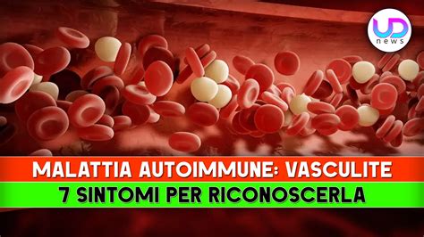 Schema di malattia autoimmune sistemica