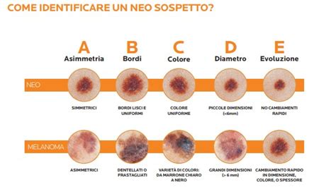 Immagine dermatoscopica di un neo benigno vs. un nevo sospetto