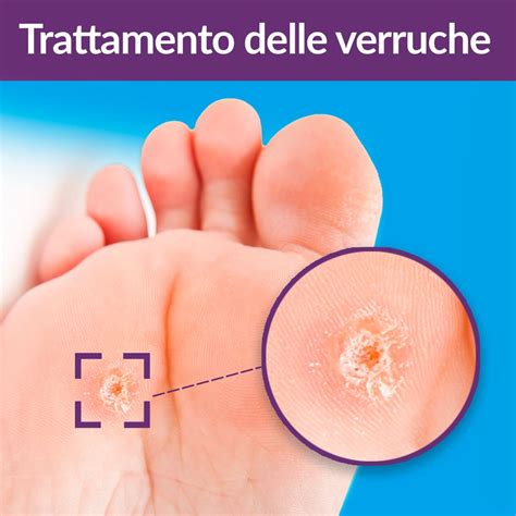 Immagine di verruche su mani e piedi