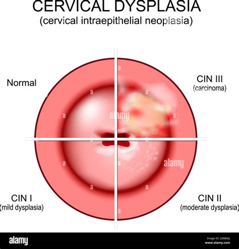 Illustrazione della cervice uterina e delle zone interessate dal Pap test