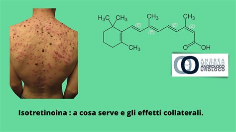 Diagramma degli effetti collaterali dell'isotretinoina