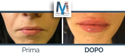 Filler labbra prima e dopo