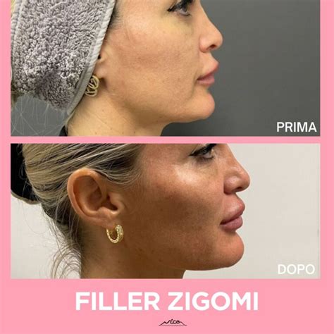 Raffronto tra un volto con zigomi definiti e uno con edema