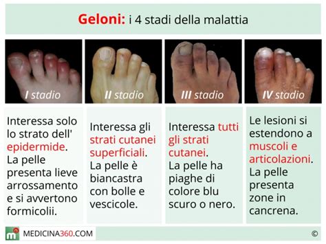 Immagine ravvicinata di mani e piedi con lesioni simili a geloni