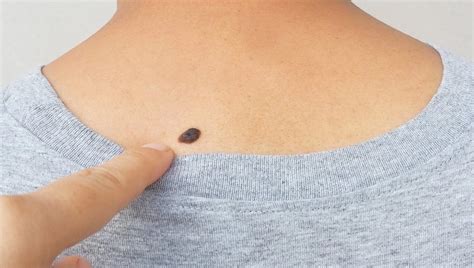 Melanoma nodulare su cute