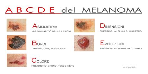 Esempi visivi delle diverse tipologie di melanoma (ABCDE)