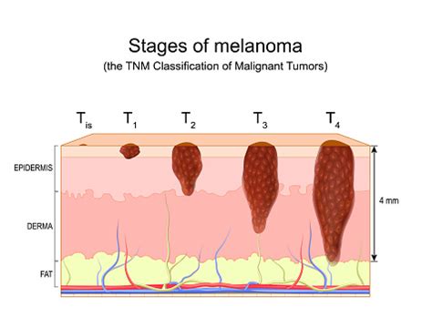 Diagramma che illustra gli stadi del melanoma secondo la classificazione TNM