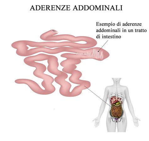 Diagramma che illustra le aderenze interne dopo un intervento chirurgico addominale