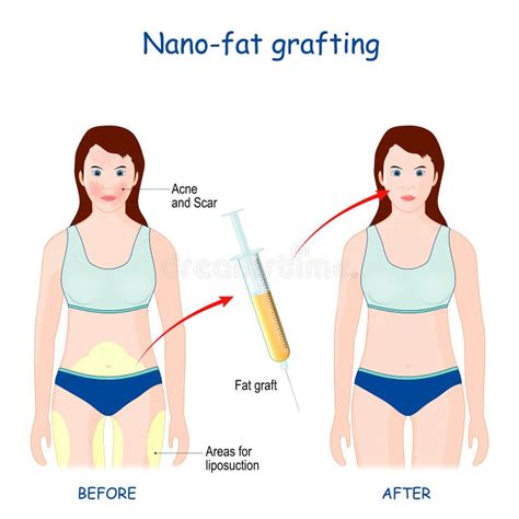 Illustrazione del processo di Nanofat, mostrando la preparazione e l'iniezione