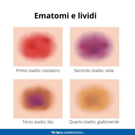Schema di un livido che cambia colore nel tempo