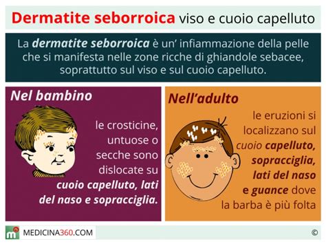 Distribuzione tipica della dermatite seborroica sul viso e sul cuoio capelluto