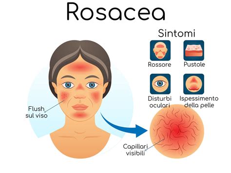 Manifestazioni tipiche della rosacea sul viso, con rossore e teleangectasie