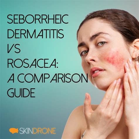 Infografica comparativa: Rosacea vs Dermatite Seborroica