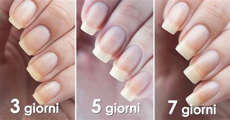 Immagine comparativa di unghie sane e unghie affette da onicomicosi