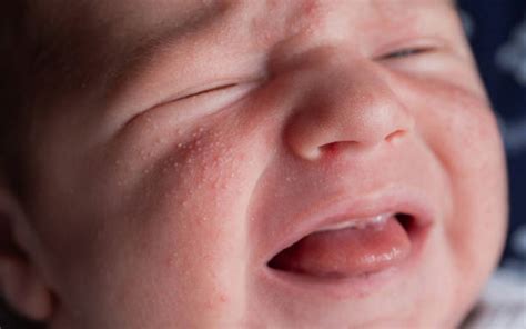 viso di un neonato con acne