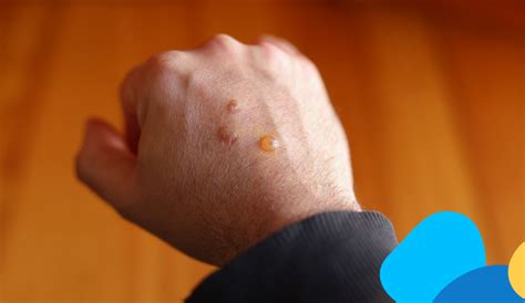 Illustrazione di mani con arrossamento e vescicole, simbolo di dermatite allergica da contatto