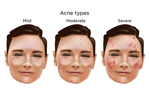 Esempio di acne severa trattata