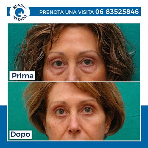 Prima e dopo un intervento di blefaroplastica
