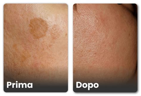 Immagine comparativa di pelle con macchie scure prima e dopo il trattamento con acido azelaico