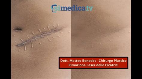 Esempio di cicatrice creata con collodio cicatrici