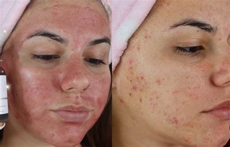 Donna che riceve un trattamento peeling viso