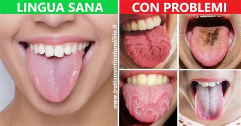 Immagine che mostra la lingua con la tipica patina bianca della candidosi orale