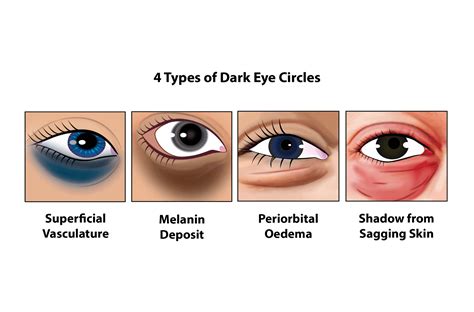 Schematic representation of the eye area with dark circles