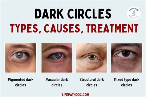 Diagram illustrating how different aesthetic treatments address dark circles