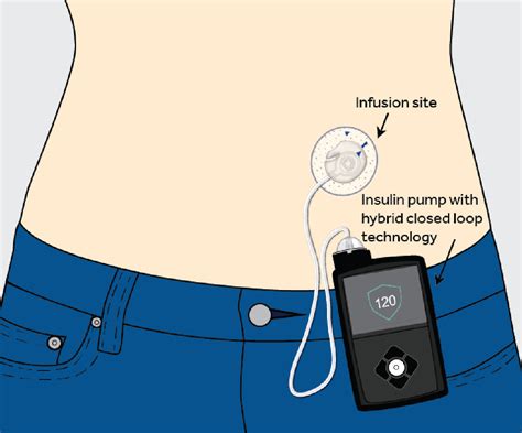 Microinfusore per insulina, compatto e discreto